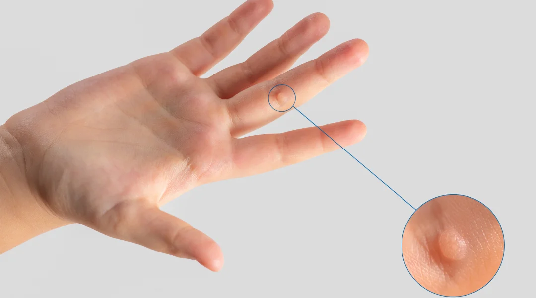 A hand delicately holds a small object, possibly illustrating various types of warts for educational purposes.