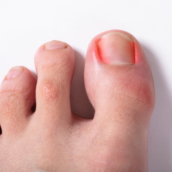Close-up of a person using a metal file to trim their toenails, illustrating common causes of ingrown toenails.